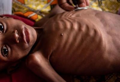 Unicef faz alerta para 10 milhões de crianças em desnutrição severa