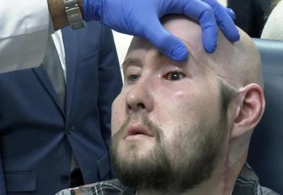 Cirurgiões em Nova York anunciam o primeiro transplante de olho inteiro do mundo