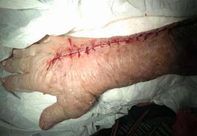 Ao retirar o gesso, técnico corta o braço de idosa em hospital do Rio