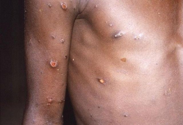 OMS aponta para mais de mil casos de varíola dos macacos no mundo