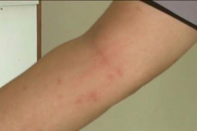 Cidade gaúcha registra mais de 200 casos de alergia à mariposa 