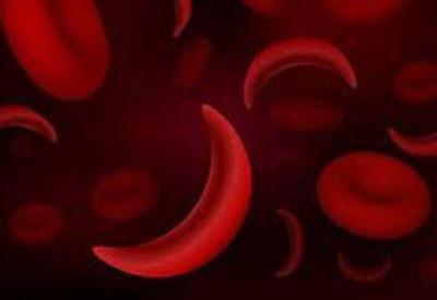 EUA aprovam terapias de edição genética para tratar anemia falciforme