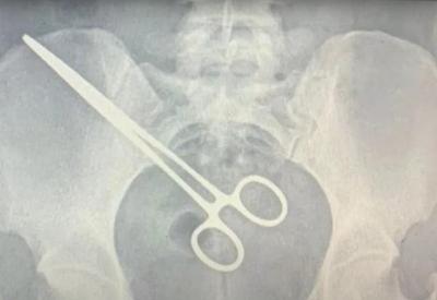 Mulher passa dois meses com pinça cirúrgica esquecida no abdômen