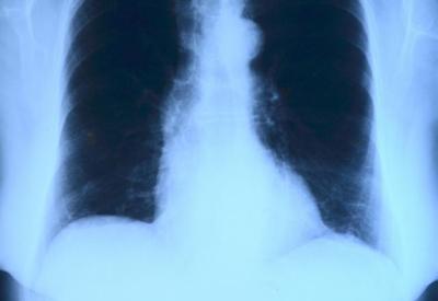 Covid-19 pode causar danos nos pulmões por mais de 90 dias