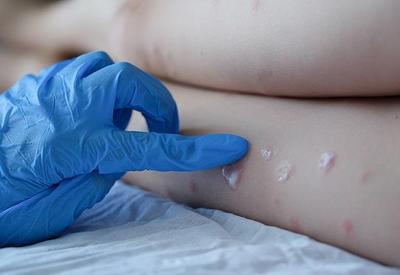 Itália autoriza quarentena para casos de varíola dos macacos