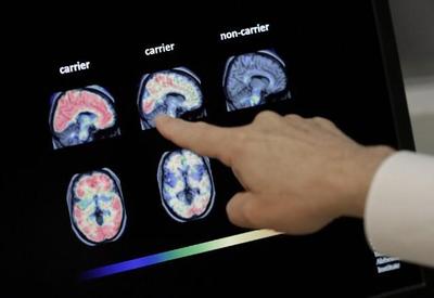 Lecanemab: remédio experimental consegue retardar progressão do Alzheimer