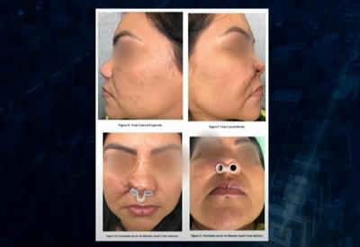 GO: mulher perde parte do nariz após procedimento estético