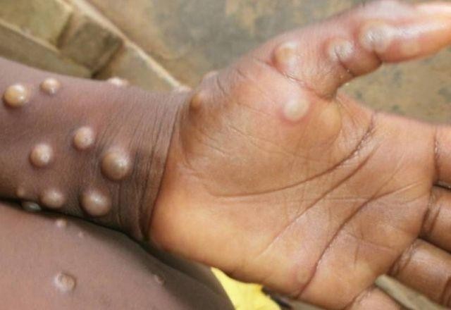 OMS classifica varíola dos macacos como emergência global