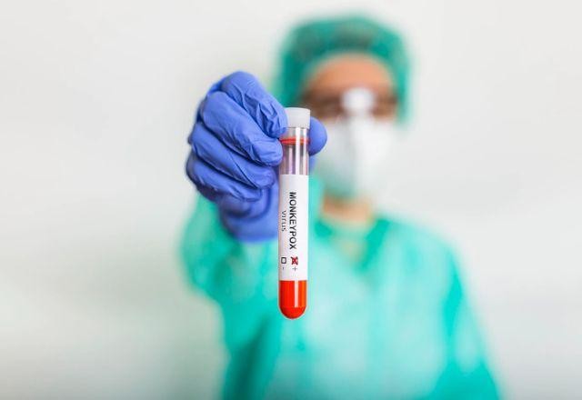 Ministério da Saúde confirma mais três casos de varíola dos macacos