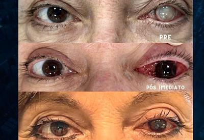 Técnica de reconstrução ocular reverte aparência do chamado "olho branco"
