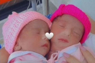 Gêmeas siamesas ligadas por um só coração morrem em hospital de Brasília