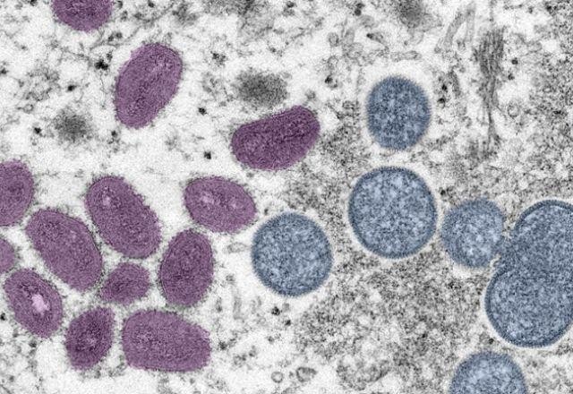 Ministério da Saúde confirma primeira morte por varíola dos macacos