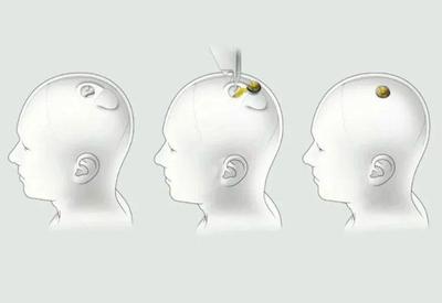 Neuralink consegue autorização da FDA para testar implantes em cérebros humanos