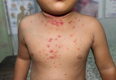 Sintomas, transmissão, vacina: o que você precisa saber sobre a varíola dos macacos